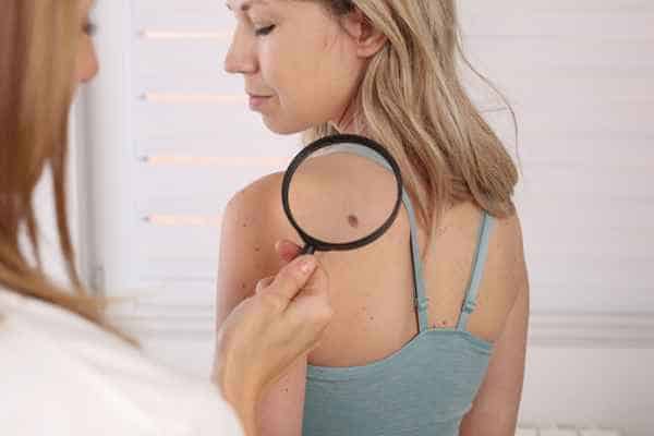 What Are Traditional Skin Lesion Removal Methods Sale?