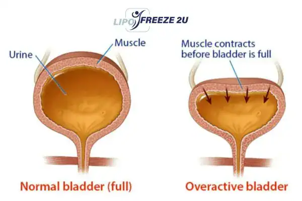 diagram of overactive bladder treatment Sale