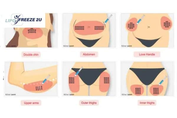 Benefits of Choosing Aqualyx for Fat Reduction Sale