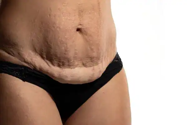 loose skin after weight loss injections Sale