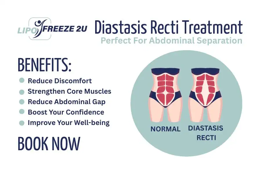 How Long Will It Take to See Improvements in Diastasis Recti Sale