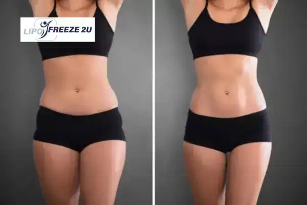 How Can LIPO FREEZE 2U Support Your Post-Pregnancy Body Recovery Sale?