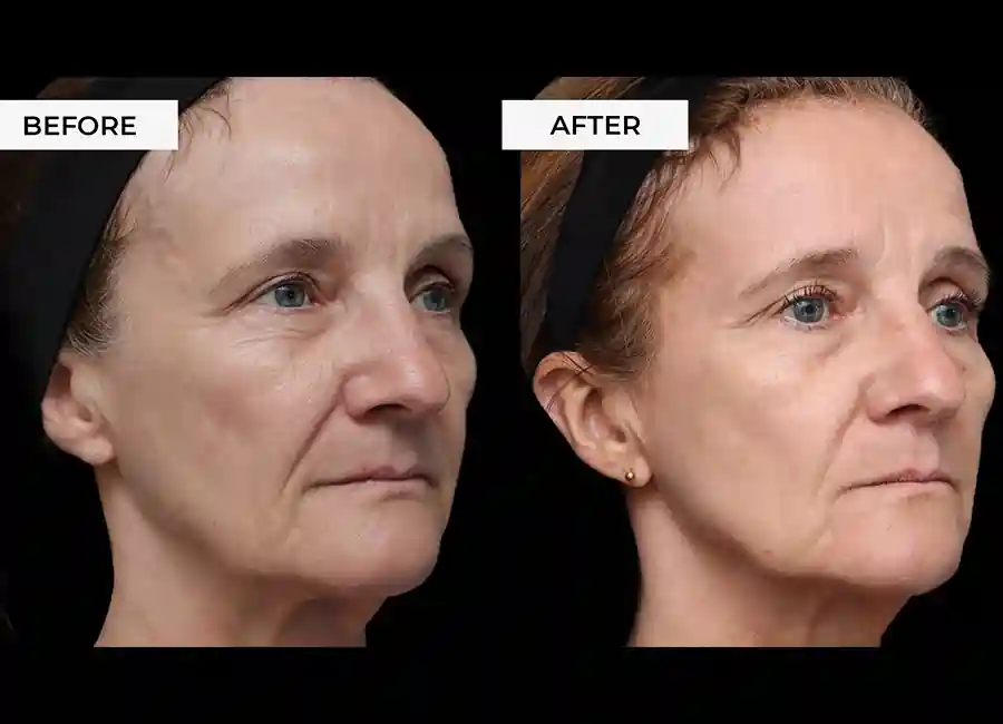 How Many RF Microneedling Sessions Will You Need to See a Difference Sale?